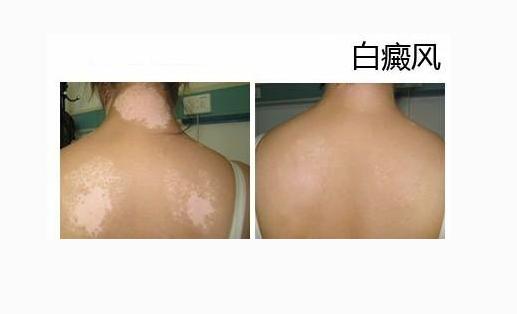 脸上的白癜风发展的太快好冶吗,在这个看脸的时代颜值有多重要