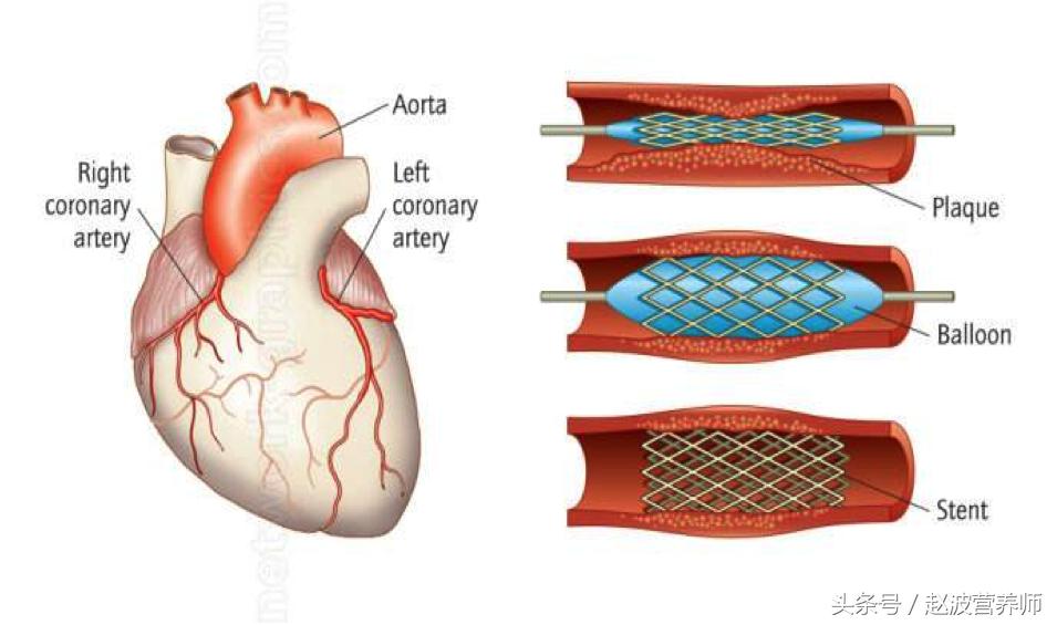 专家讲解心脑血管病治疗方法,心脑血管病怎么治疗最有效