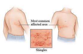 腹股沟皮疹什么原因,皮疹长期不愈什么原因