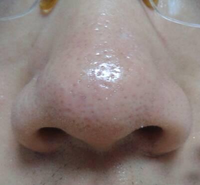 鼻子挤出的白色“条状物”是什么？要怎样才能将它们清理彻底！