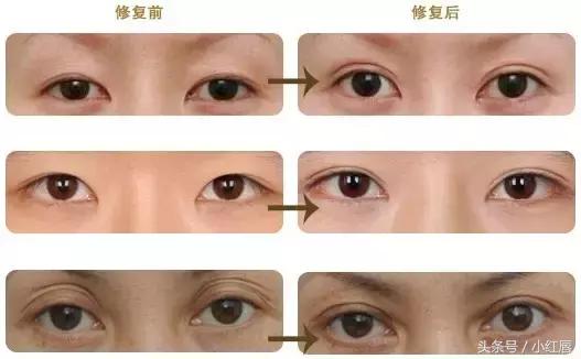 闺蜜割了双眼皮,割了双眼皮后悔了一个月
