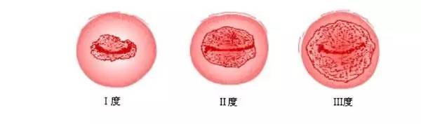 小颈,小颈的意思