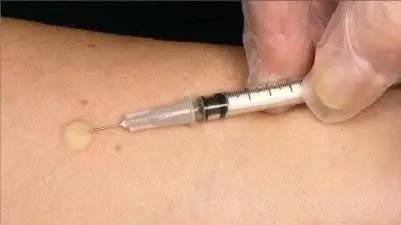 患者对酒精过敏怎么消毒,酒精过敏怎么做手术