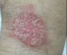 牛皮癣好了告别银屑病,华西看银屑病厉害的医生