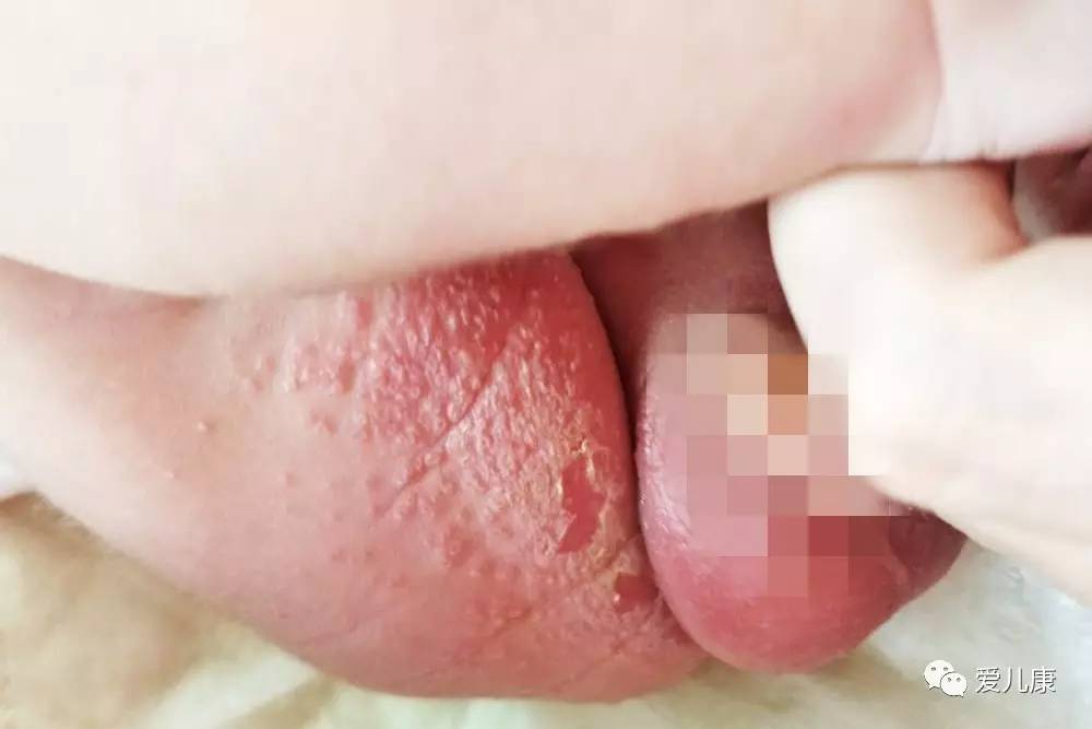 宝宝耳朵里流黄水照片,宝宝耳朵流黄色液体一般咋检查