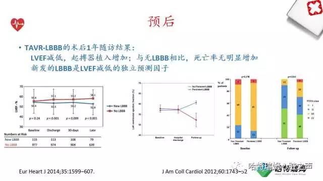 「心声」从机制到临床，一起认识左束支阻滞！