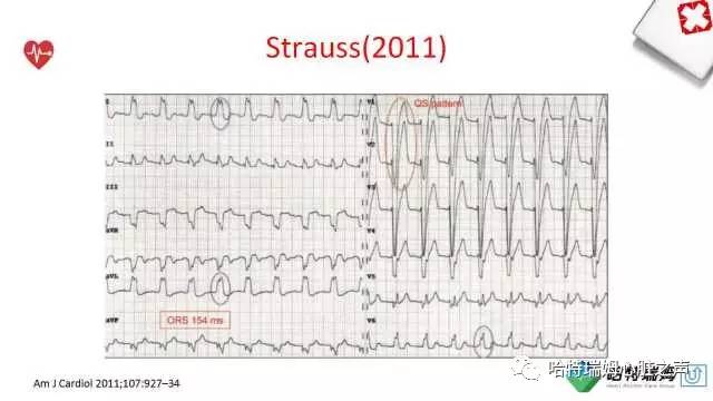 「心声」从机制到临床，一起认识左束支阻滞！