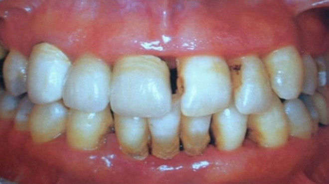 牙齿缝隙大怎么办最有效的办法,牙齿缝隙越来越大怎么补救