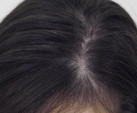 头皮上有一层厚厚的白色的头皮屑,头皮上有一层白色的头皮屑