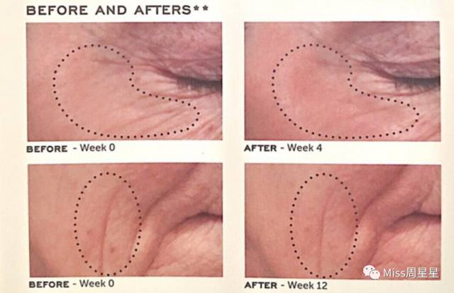 iluminage激光美容仪有哪些功效,紧致去皱美白美容仪