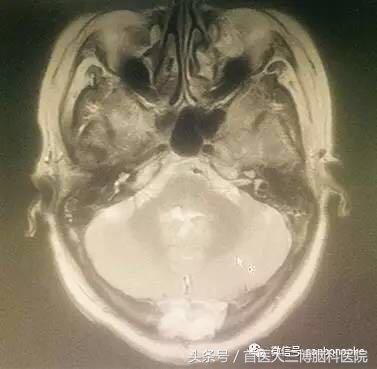 半年内多次脑出血心生绝望，学病友“跟风求医”