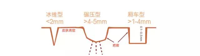 娣″寲鐥樺嵃鐥樺潙姣涘瓟绮楀ぇ鐢风敓,骞垮窞娣″寲鐥樺嵃鐥樺潙姣涘瓟绮楀ぇ