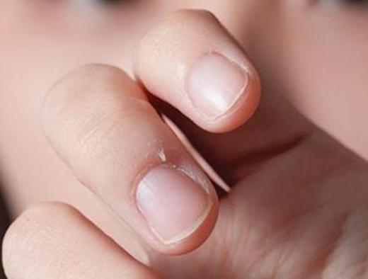 指甲旁边倒刺如何消灭,婴儿指甲旁边长倒刺