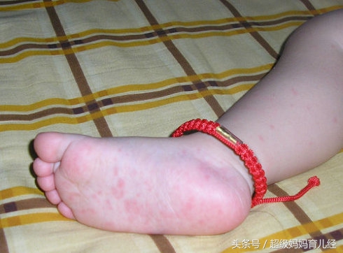 宝宝得了幼儿急疹怎么办,幼儿急疹出了疹子还发烧