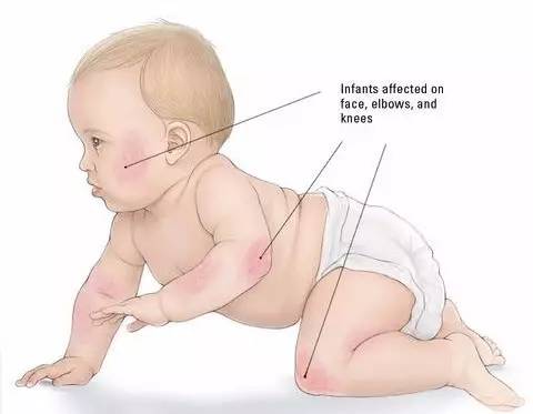 宝宝湿疹一直反反复复怎么办,宝宝湿疹反反复复一直不好怎么办