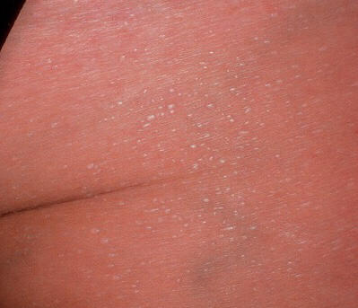 治疗婴儿痱子最快速有效的方法,宝宝头上的痱子治疗小妙招