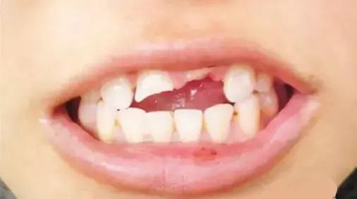 牙齿因外伤磕得快掉了该怎么办,牙齿摔坏了一半怎么办