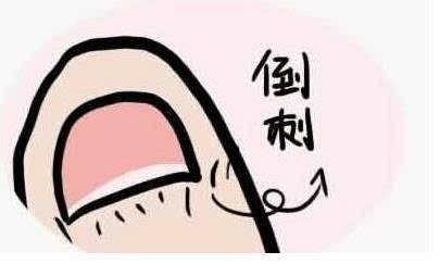 指甲旁边倒刺如何消灭,婴儿指甲旁边长倒刺