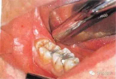 口腔拔牙图片,口腔拔牙麻醉多久消退