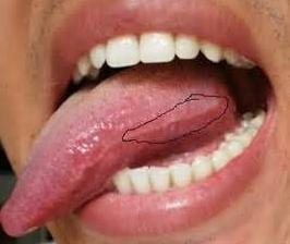 口腔里的“假癌症”(口腔科普第21期)