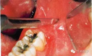 口腔拔牙图片,口腔拔牙麻醉多久消退