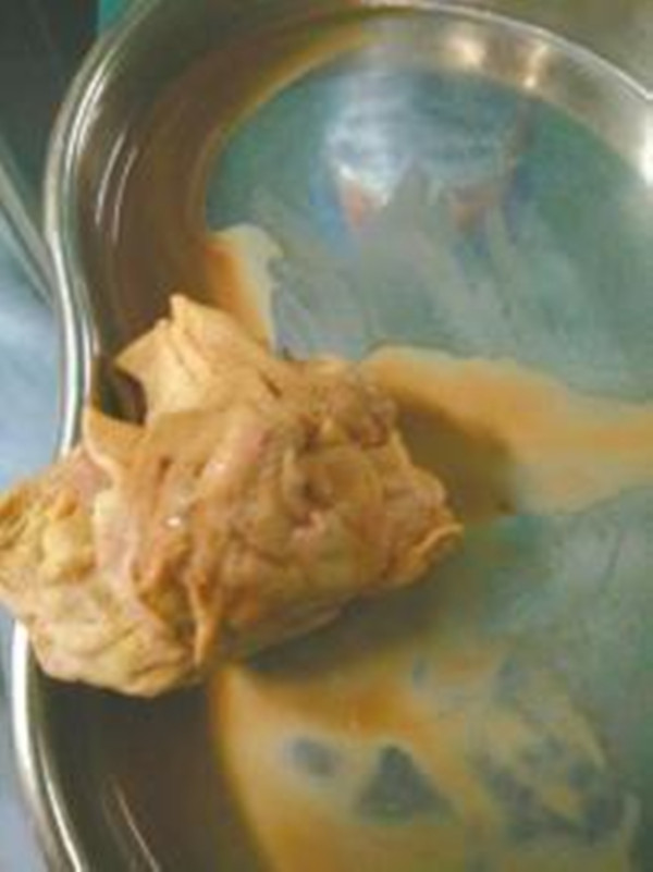 剖腹产3年之后肚子好疼,剖腹产三年后肚子里面疼