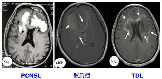 医学干货：瘤样炎性脱髓鞘病与胶质瘤、PCNSL临床、影像鉴别