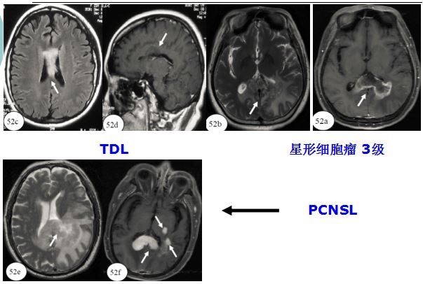医学干货：瘤样炎性脱髓鞘病与胶质瘤、PCNSL临床、影像鉴别