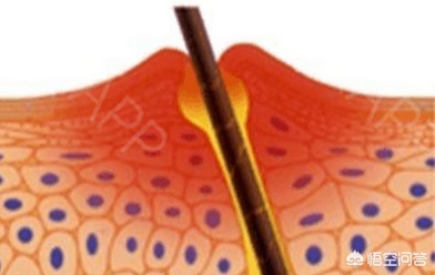 治疗青春痘瘢痕疙瘩的药,专治青少年青春痘粉刺螨虫药膏