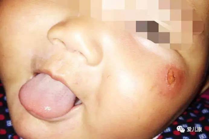 被蚊子咬后水泡破用什么药,被蚊子咬了起脓水泡能戳破吗