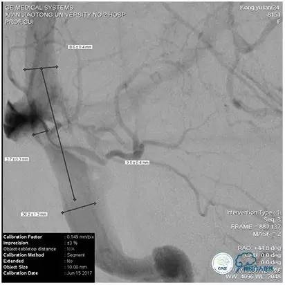 静脉窦狭窄支架植入术,静脉窦狭窄做支架多少钱