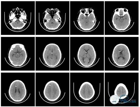 脑静脉窦狭窄做支架危险吗,静脉窦狭窄做支架后多久恢复