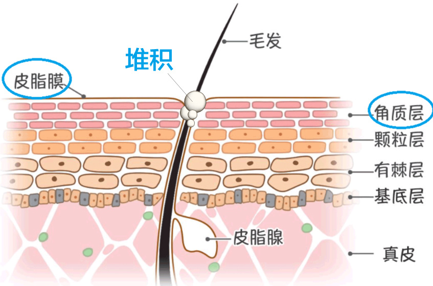 孩子长闭口粉刺怎么办,闭口粉刺总是长怎么办呢