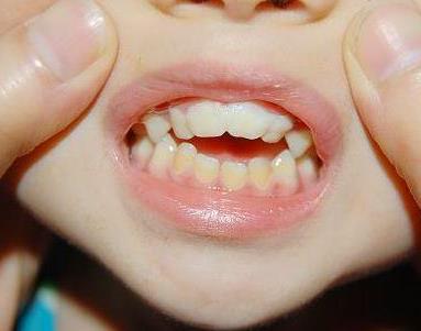 小孩牙齿地包天的原因,牙齿地包天是什么原因造成的