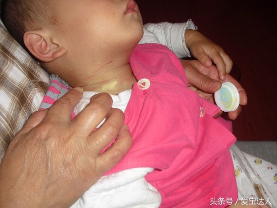 高温天气宝宝淹脖子,宝宝汗淹了脖子怎么办