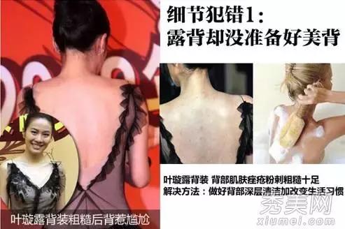 背部痘痘如何快速解决,背部痘痘反复长不停如何正确祛痘