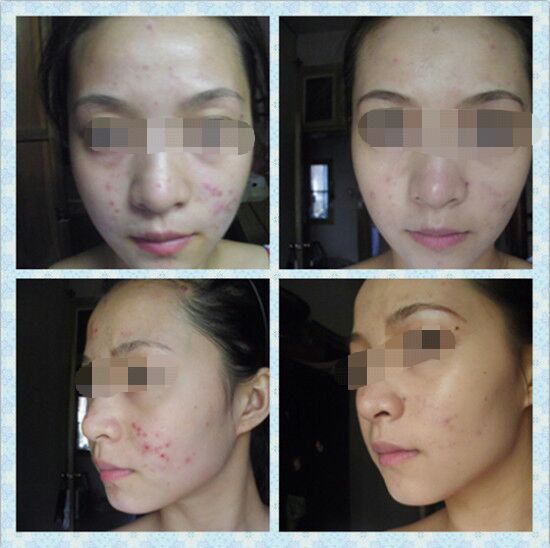 额头痘痘反反复复下不去,额头下巴总是反复长痘痘怎么去除