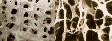 宣武医院肠梗阻,老王摔了一跤断了两根肋骨