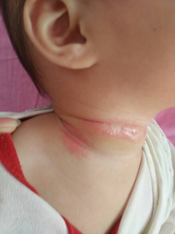 宝宝夏天淹脖子用什么好,夏季宝宝淹脖子怎么办