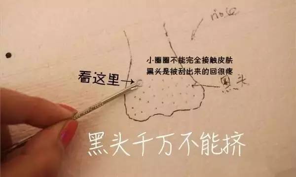 “黑头”这个渣男，彻底和他Say byebye~