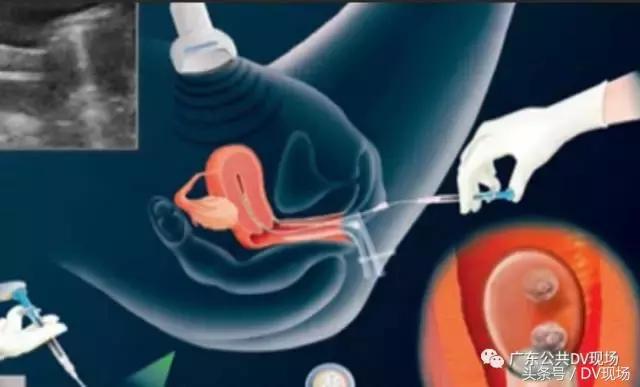 悲剧!广州妙龄女子为赚1.5万卖卵,不幸肚子变大