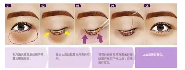 切除眼袋是唯一解决眼袋的方法,眼袋切除方法有哪些