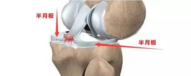 膝盖韧带和半月板受伤可以热敷吗,半月板受伤能彻底治愈吗