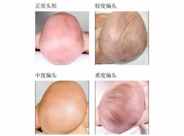 婴儿三个月头型还可以矫正吗,新生儿头型长怎么矫正