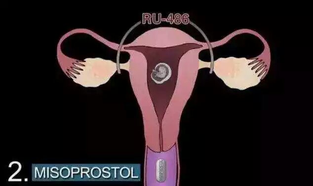 男的会接受女朋友打胎吗,你会建议你的女朋友打胎吗