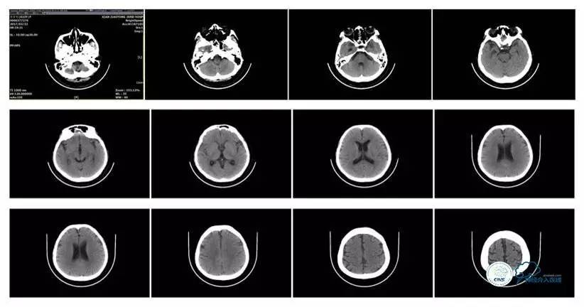 脑静脉窦狭窄做支架危险吗,静脉窦狭窄做支架后多久恢复