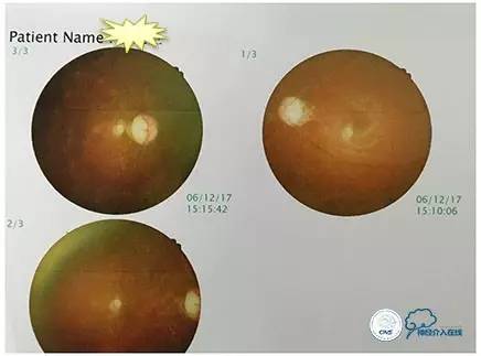 脑静脉窦狭窄做支架危险吗,静脉窦狭窄做支架后多久恢复