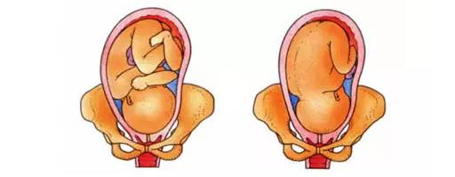 到底要不要检查胎位,如何正确判断胎位
