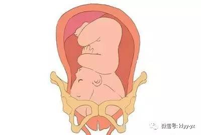 分娩胎头下降的过程,临产胎头下降什么感觉