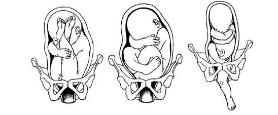到底要不要检查胎位,如何正确判断胎位